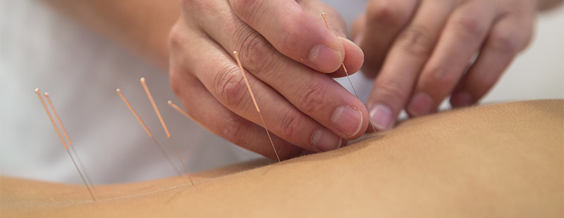 Ein Bild auf dem eine Person auf dem Bauch liegt und von einer weiteren Person Nadeln in den Rücken gesetzt bekommt.
