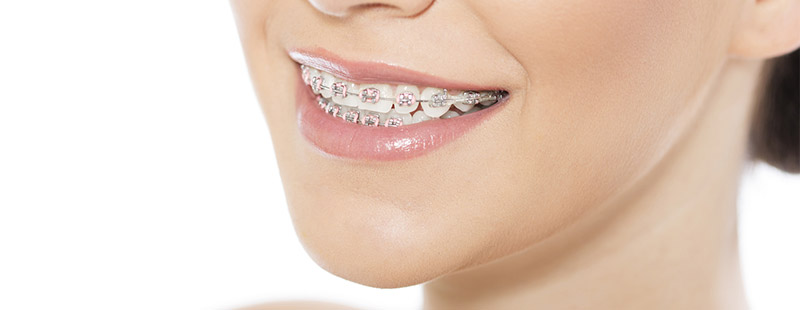 Eine Frau die eine Zahnspange trägt und diese mit Offenem Mund zeigt.